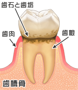 京都市中京区の歯科 あきデンタルクリニック 歯周病